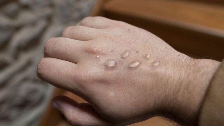 Cross River Confirms First Mpox Case in Obudu Local Government Area